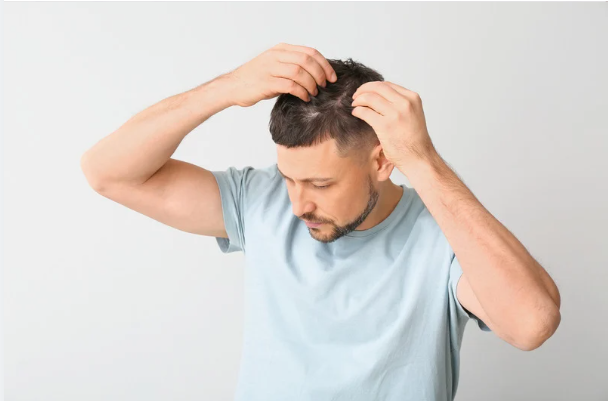 Regrowing Hair Has Never Been Easier: Benefits of the 6-Month Kirkland Minoxidil Treatment