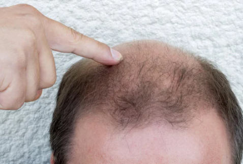 6 Reasons to Choose Kirkland Minoxidil 5% for Hair Loss