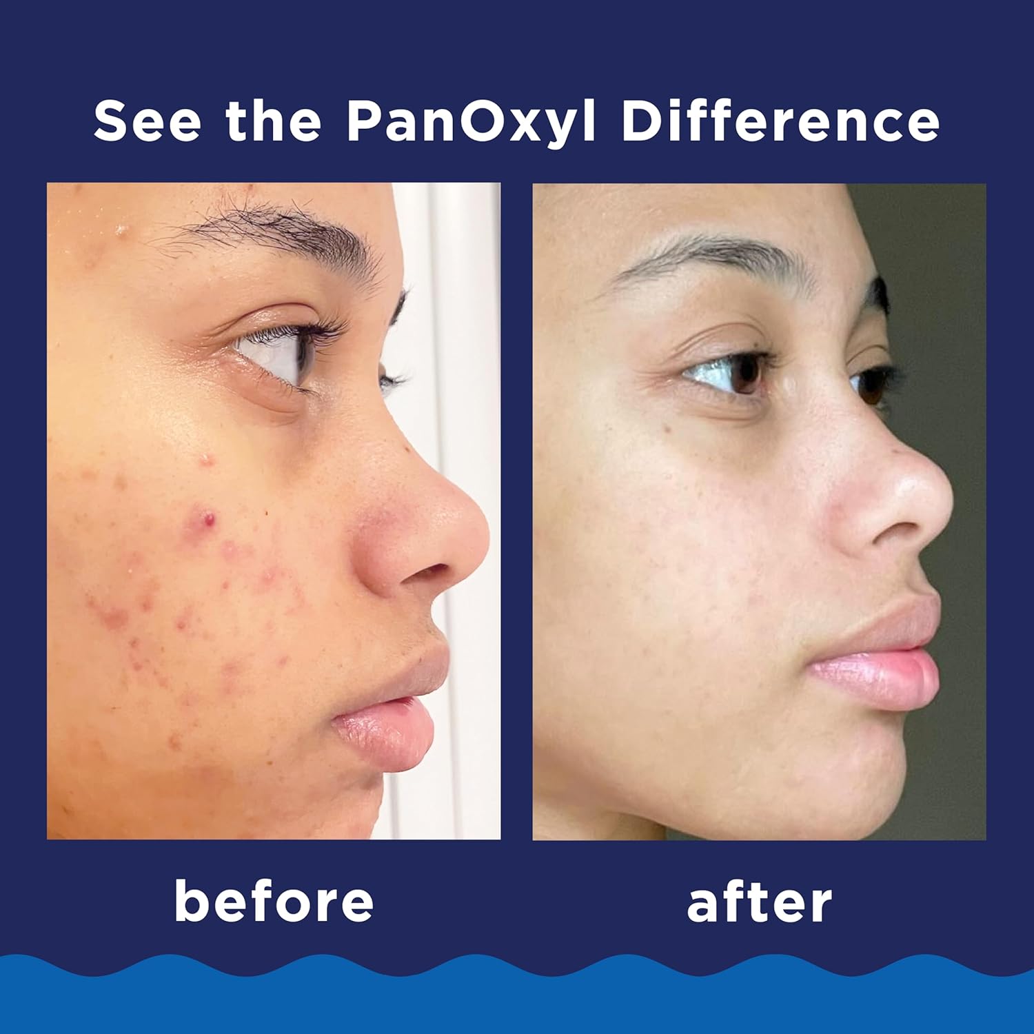 PanOxyl Acne Foaming Wash Benzoyl PeroxidePackage